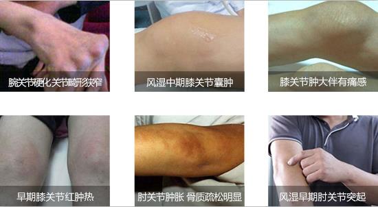 郑州痛风风湿病医院风湿性关节炎症状.jpg