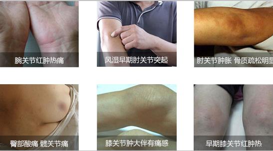 郑州痛风风湿病医院风湿性关节炎早期症状.jpg