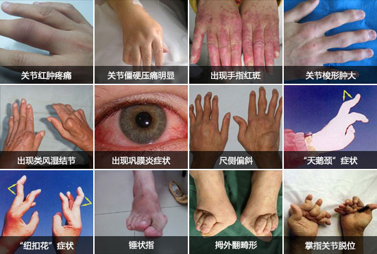 郑州痛风风湿病医院类风湿不及时治疗造成的危害.jpg