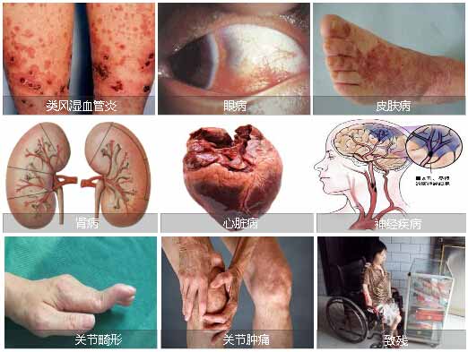 郑州痛风风湿病医院类风湿性关节炎可引起全身多处部位病变.jpg