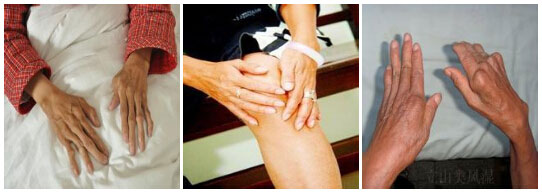郑州痛风风湿病医院老年类风湿出现关节疼痛、僵硬、畸形.jpg