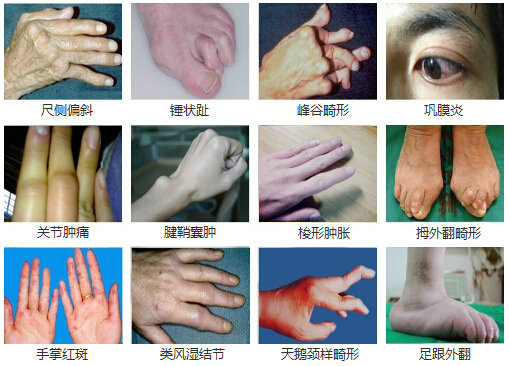 类风湿症状表现及产生的危害外在变现形式.jpg