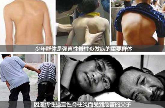 郑州痛风风湿病医院遗传性强直性脊柱炎对青少年的危害.jpg