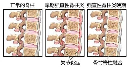郑州痛风风湿病医院强直性脊柱炎病发机理示意图.jpg