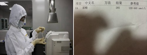 郑州痛风风湿病医院尿酸检查.jpg
