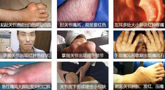 郑州痛风风湿病医院痛风发病的症状.jpg